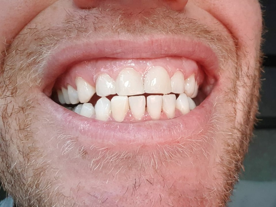 אחרי טיפול שיניים