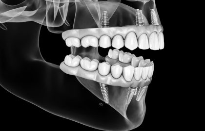 השתלת שיניים דיגיטלית